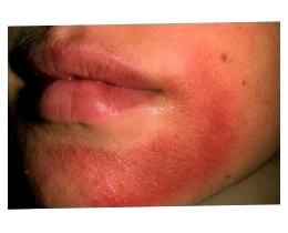 Алергічний дерматит на обличчі