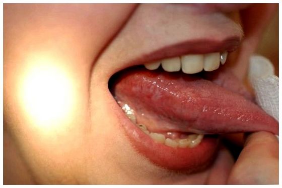 Болить кінчик язика: причини і як можна позбутися від болю