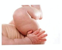 Дисплазія кульшового суглоба у дитини