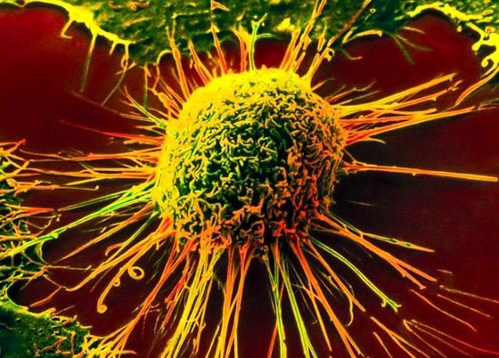 Де в світі найбільше хворіють на рак?