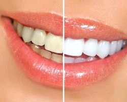 Як позбутися від білих плям на зубах