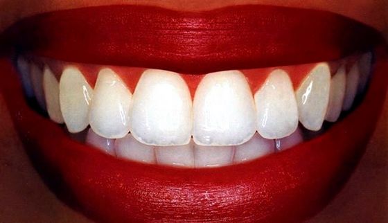 Як позбутися від білих плям на зубах