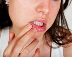 Як позбутися від застуди на губах - прості і дієві рецепти
