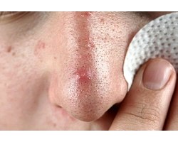 Як лікуватися від вугрової висипки на носі?