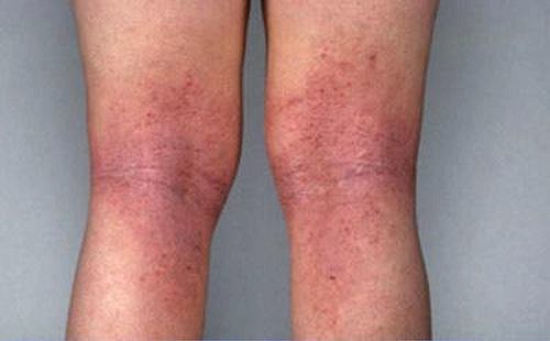 Червоні плями на ногах: причини появи і фото