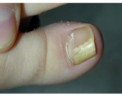 Лікування грибка на нігтях ніг