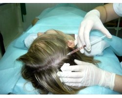 Лікування волосся мезотерапією