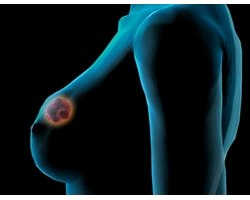 Онкологічні захворювання: рак грудей