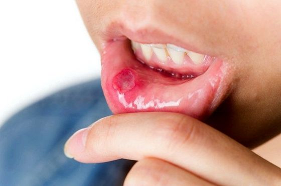 Опухла губа: причини і лікування