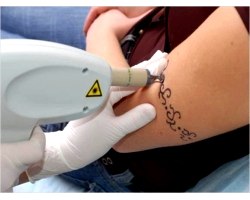 Основні методи позбавлення від татуювань