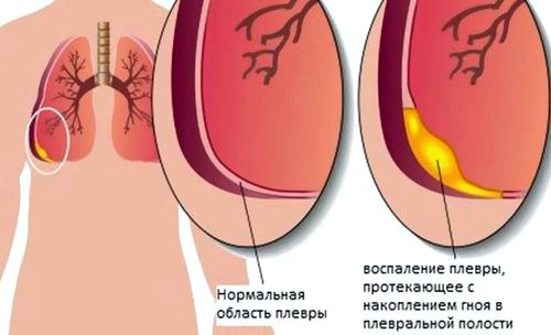 Печіння в грудній клітці: кардіогенний і Некардіогенний причини